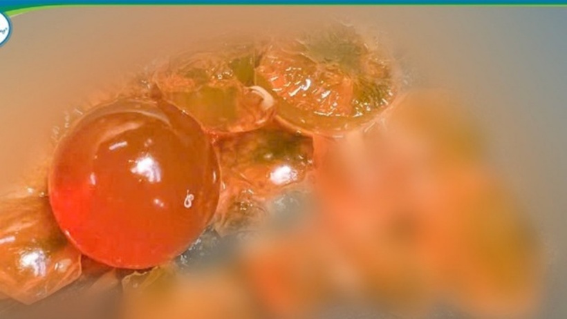 Dị vật được lấy ra từ bụng bệnh nhi là những hạt nhựa nhỏ, có khả năng trương nở khi gặp nước. Ảnh: Người đưa tin.