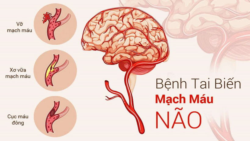 Tai biến mạch máu não xảy ra khi mạch máu bị tắc nghẽn hoặc vỡ, dẫn đến thiếu oxy và gây tổn thương tế bào não