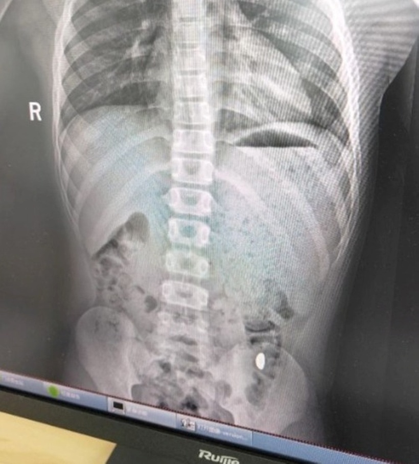 “Vật thể lạ trong dạ dày” cậu bé. Ảnh: Baidu.