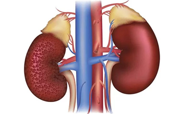 Thận yếu là tình trạng suy giảm chức năng của thận