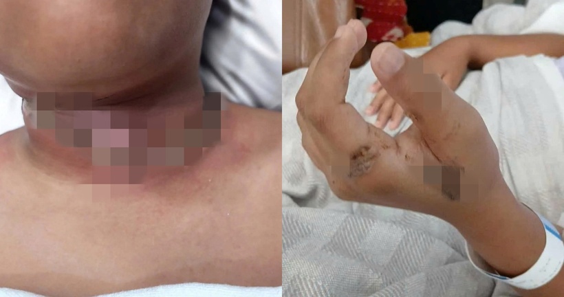 Bé trai bị bỏng nặng.