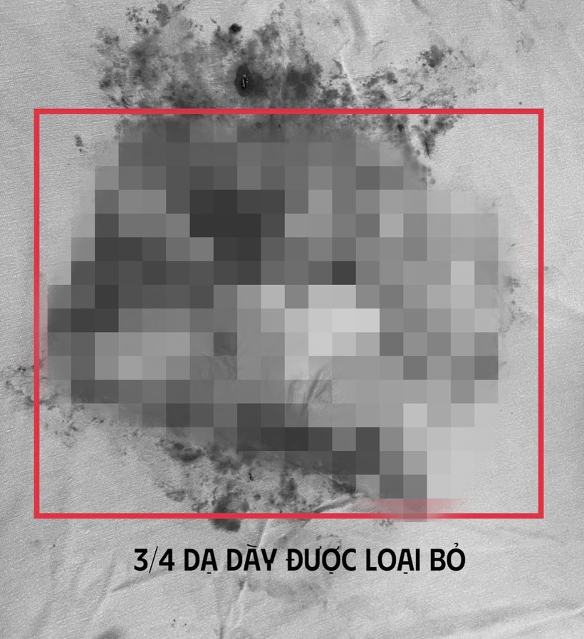 Người đàn ông 60 tuổi mang nhiều bệnh nền nghiêm trọng phải mổ ung thư dạ dày trong tình trạng suy kiệt, nguy cơ biến chứng cao.