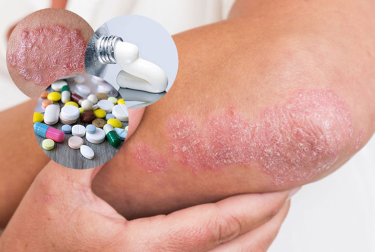 Thuốc tây điều trị vảy nến cần tuân theo đúng chỉ định của bác sĩ