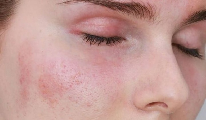 Sưng mắt do các vấn đề liên quan đến thận thường dai dẳng và cũng có thể kèm theo các triệu chứng khác như nước tiểu có bọt hoặc sủi bọt.