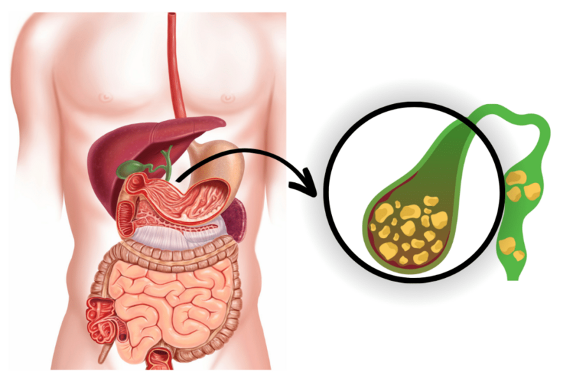 Sau phẫu thuật cắt túi mật, sỏi mật vẫn có thể tái phát.