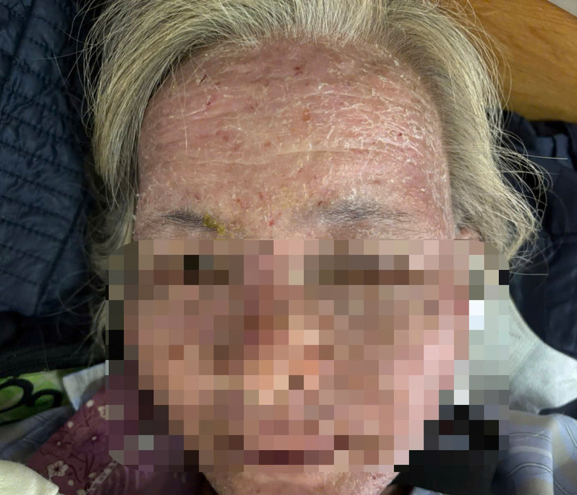 Bà L nhập viện trong tình trạng toàn thân nề đỏ, nứt nẻ, bong vảy, sốt và ngứa nhiều