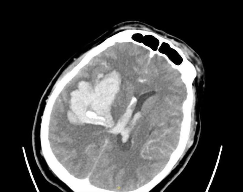 Hình ảnh phim chụp bệnh nhân bị xuất huyết não lượng lớn bán cầu phải. Ảnh: VietNamnet