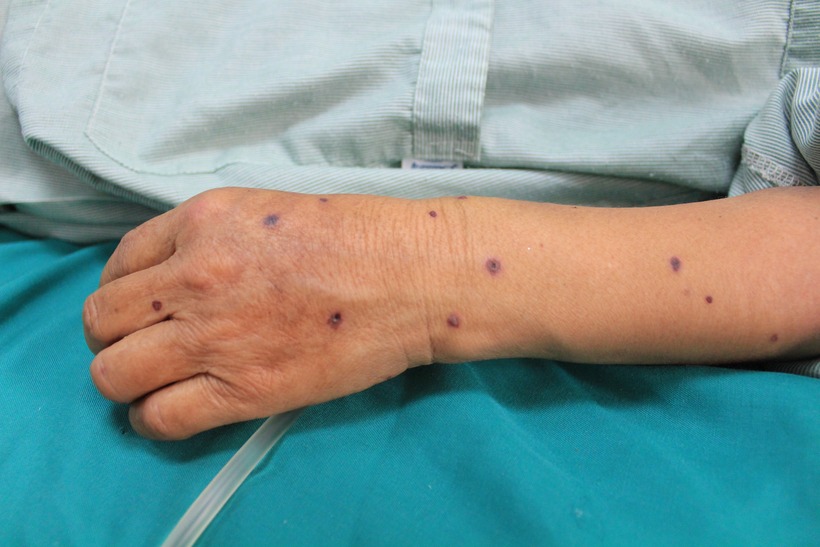 Các vết ong đốt trên tay bệnh nhân. Ảnh: BVĐK Điện Biên.