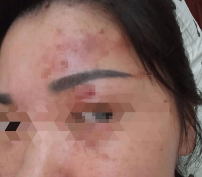 Bệnh nhân nữ nhập viện trong tình trạng đau rát dữ dội vùng mắt, kèm theo chảy nước mắt liên tục và thị lực giảm sút rõ rệt.