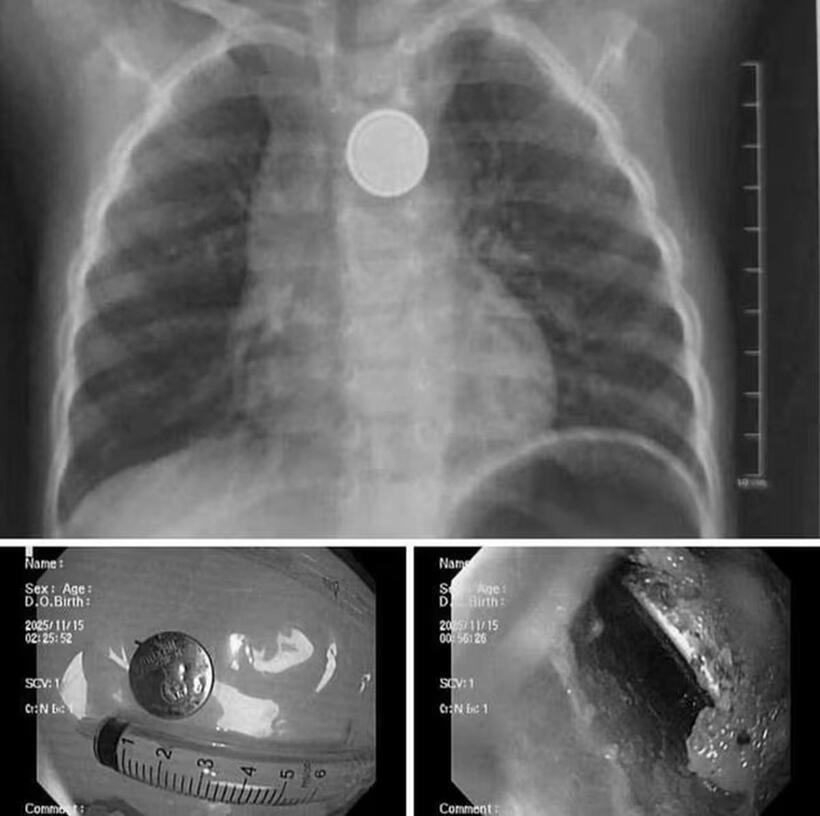 Dị vật là pin cúc áo trong thực quản trẻ. Ảnh: Người đưa tin.