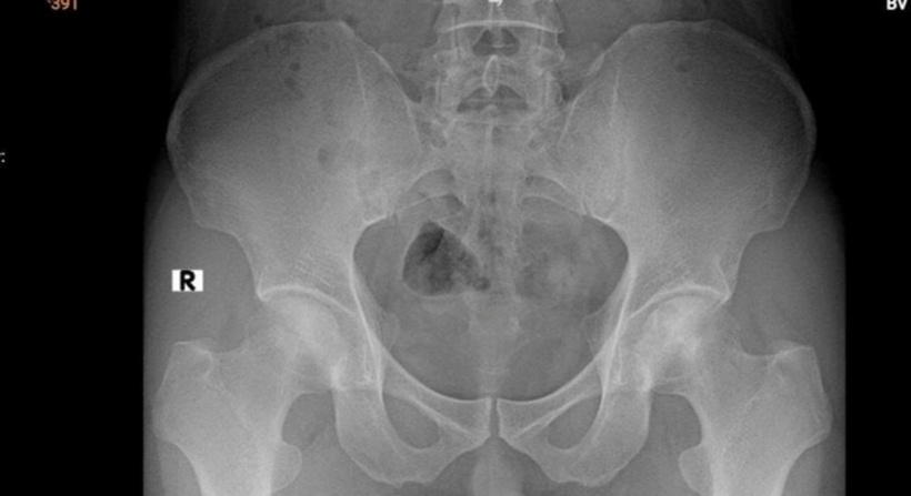 Bệnh nhân có dấu hiệu hoại tử vô mạch chỏm xương đùi hai bên độ 2 theo ficat và alert. Ảnh: Sức khoẻ & Đời sống.