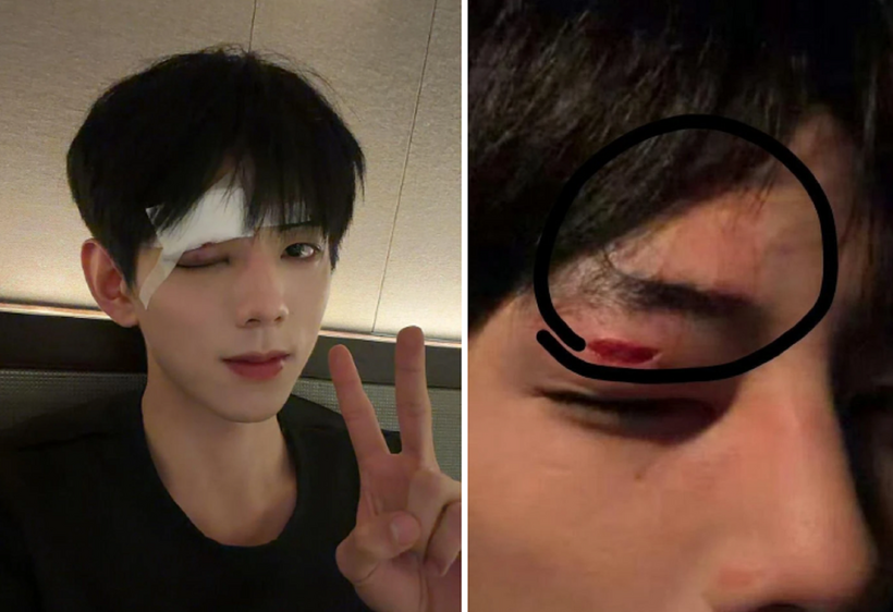 Khuôn mặt của Vương Niên Tương Thành sau khi bị bạn diễn đấm. Ảnh:&nbsp;Weibo.