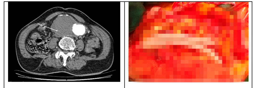 Hình ảnh khối phồng động mạch chủ lớn doạ vỡ trên Chụp CLVT (trái) và hình ảnh mạch máu nhân tạo được thay vào chỗ đoạn mạch phình cắt bỏ. Ảnh: BVCC