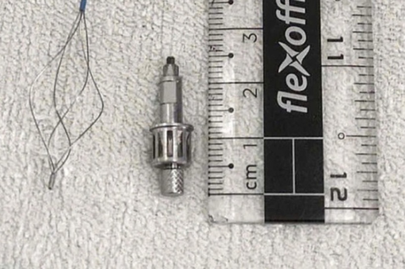 Dị vật trong phế quản bệnh nhân. Ảnh: VietNamNet.