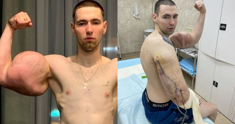 Việc lạm dụng hóa chất đã hủy hoại nghiêm trọng bắp tay của Tereshin. Ảnh: Newsflash.