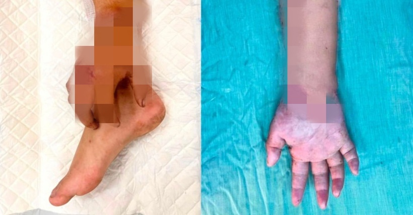 Sau thời gian "nuôi tạm" ở cẳng chân, bàn tay được ghép về vị trí cũ. Ảnh: VTC News.
