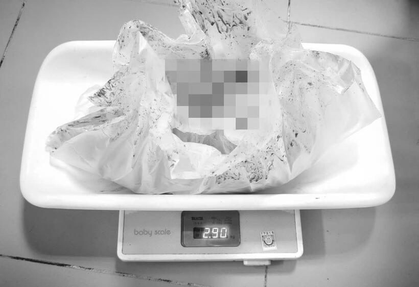 Khối u nặng gần 3kg, tương đương một em bé sơ sinh mới chào đời