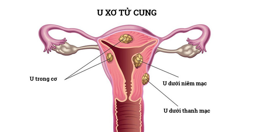 Các vị trí của u xơ tử cung
