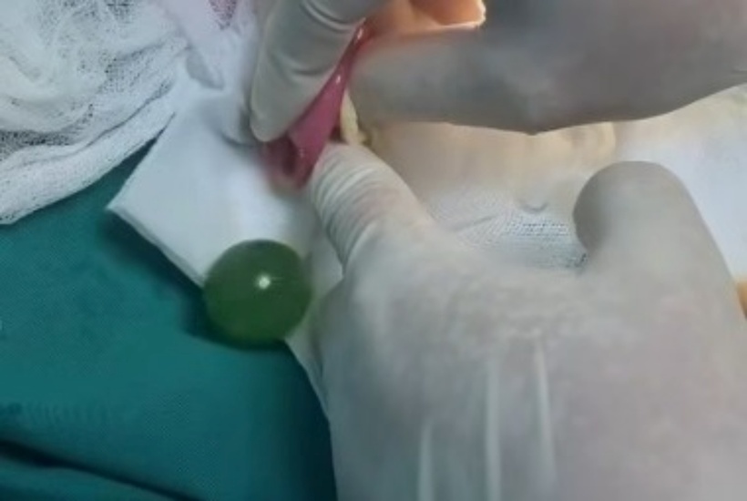 Bệnh nhi được mổ cấp cứu, lấy ra một hạt nở đã trương nở tối đa trong đường tiêu hóa. Ảnh: Tạp chí Tri Thức.