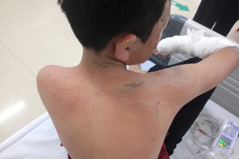 Những vết bỏng trên người bệnh nhi. Ảnh: Dân Trí.