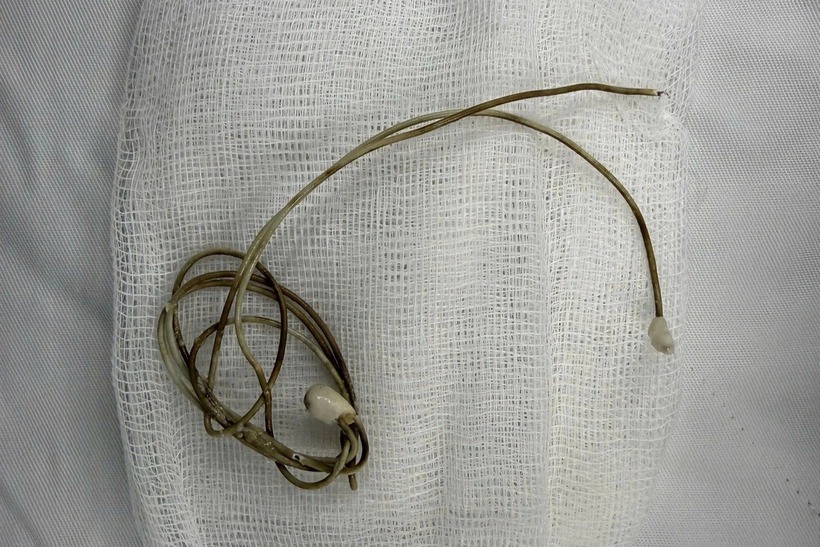 Một nam sinh 16 tuổi ở TP.HCM đã đưa dây sạc điện thoại vào niệu đạo và không thể lấy ra. Ảnh: Dân Trí.