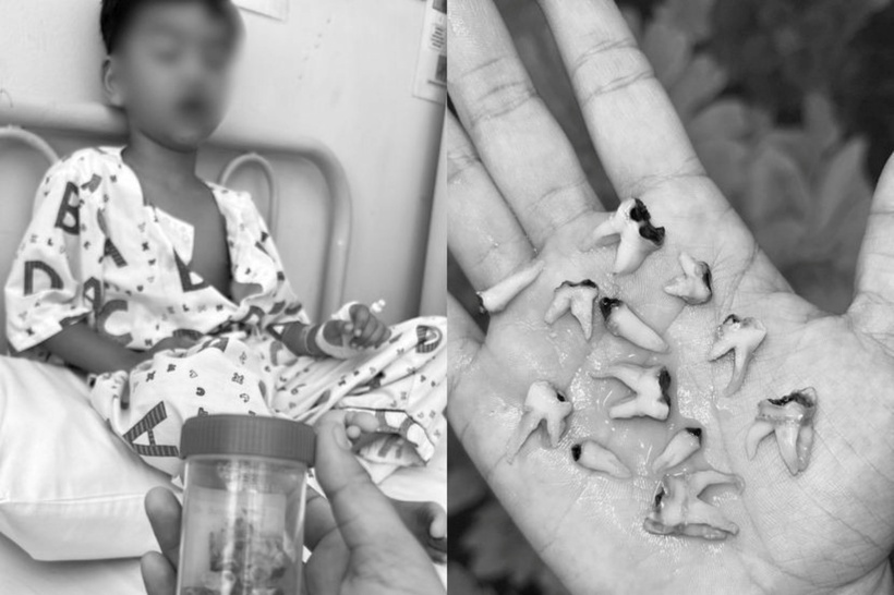 Chính sự kết hợp giữa việc bú bình kéo dài đến năm 4 tuổi và thói quen lơ là vệ sinh răng miệng đã dẫn đến tình trạng 12 chiếc răng sữa của bé trai bị sâu hủy hoại. Ảnh: Facebook Siti Nur Haiza