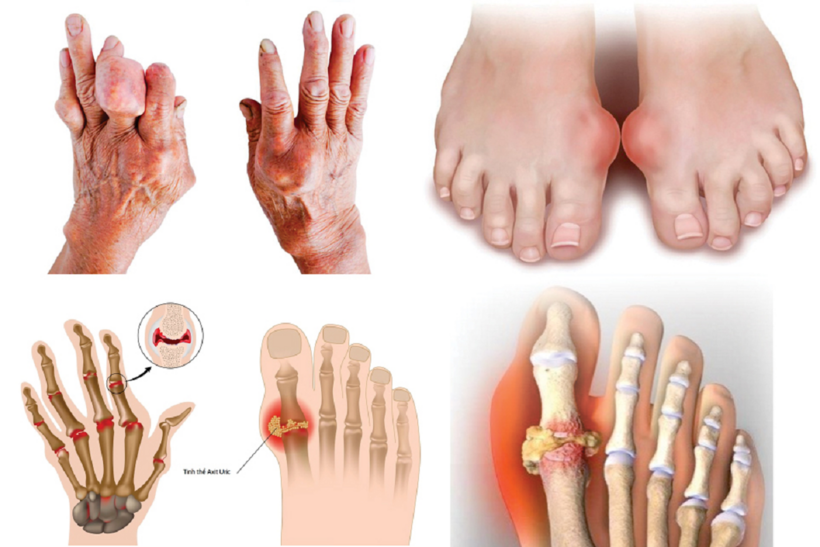 Người bệnh gút có thể bị biến dạng khớp, nổi cục tophi nếu không biết cách kiểm soát