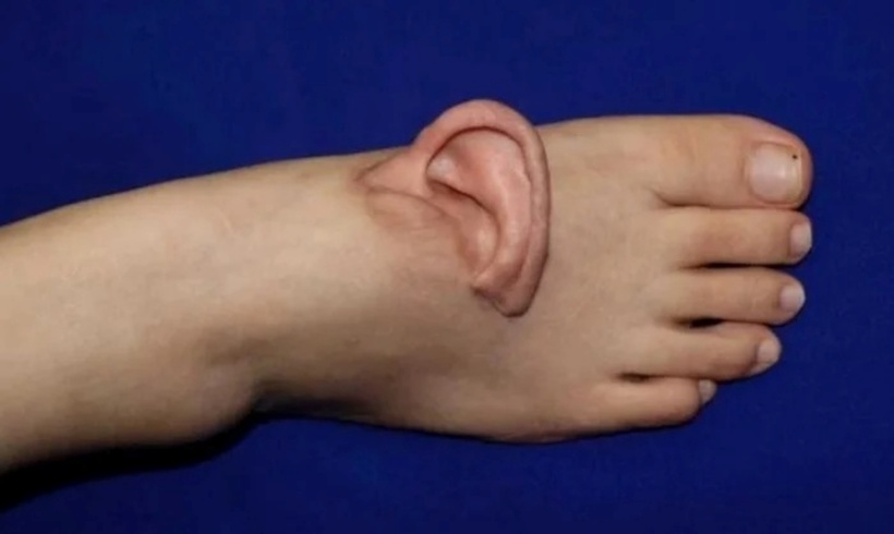 Tai của nữ bệnh nhân được cấy ghép vào chân. Ảnh: Qilu Evening News