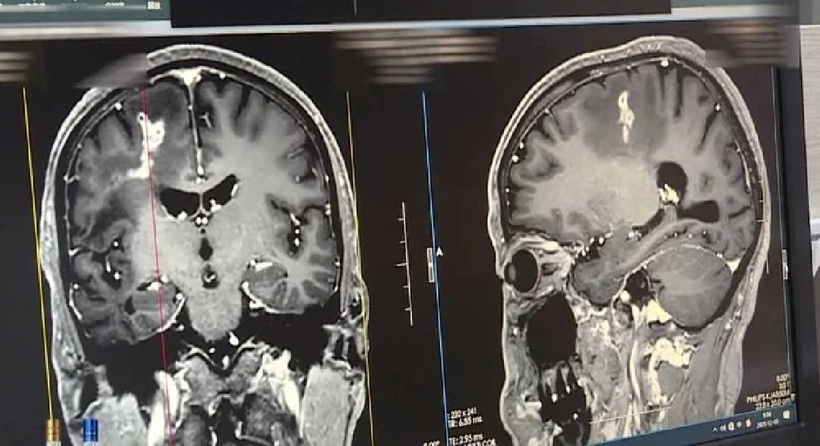 Hình ảnh cho thấy vùng trán phải của bệnh nhân xuất hiện viêm u hạt và phù não rõ rệt. Ảnh: Saostar.