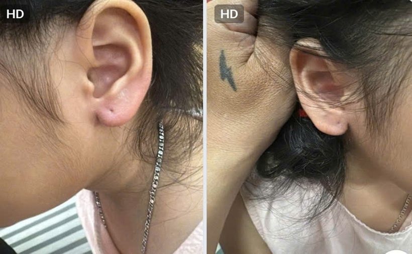 Vùng tai của bé Th bị tổn thương sau khi bị kẻ gian giật mạnh đôi bông tai vàng. (Ảnh: Lao động)