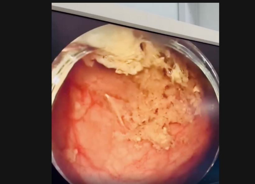 Phát hiện nhiều con giun màu trắng ngà, dài khoảng 0,3–0,5 cm, trong lòng đại tràng