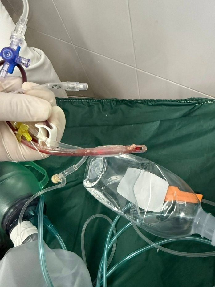 Thức ăn nghẹt dính vào ống nội khí quản sau khi y bác sĩ hồi sức tim phổi thất bại. Ảnh: NLĐ.