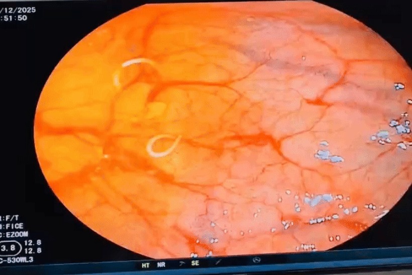 Số lượng giun lớn cho thấy bệnh nhân đã nhiễm giun trong thời gian dài nhưng không nhận biết vì triệu chứng không điển hình. Ảnh: Dân Trí.