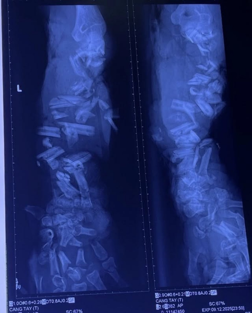 Hình ảnh phim X - quang cho thấy xương cẳng tay và bàn tay trái của bệnh nhân bị gãy từng khúc. Ảnh: Người Lao Động.