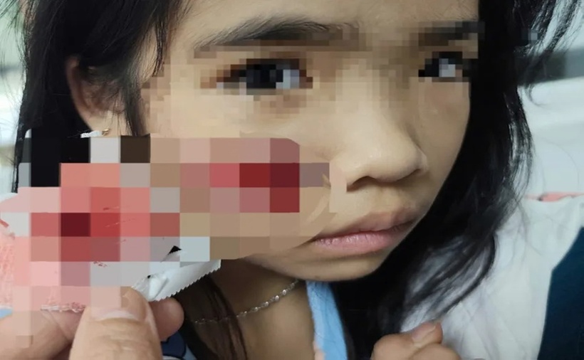 Cháu N nhập viện với nhiều vết thương. (Ảnh: PLO)