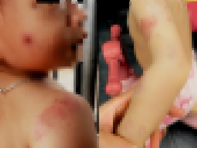 Hình ảnh bé gái bị chi chít vết cắn sau giờ học. Ảnh: VietNamnet