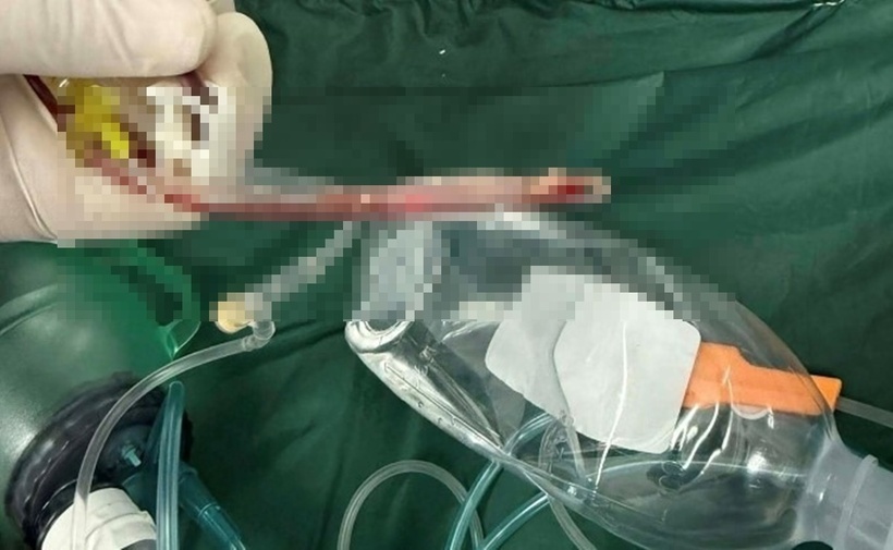 Thức ăn bám vào ống nội soi đường thở sau khi nỗ lực cứu chữa của bác sĩ thất bại. Ảnh: Tiền phong