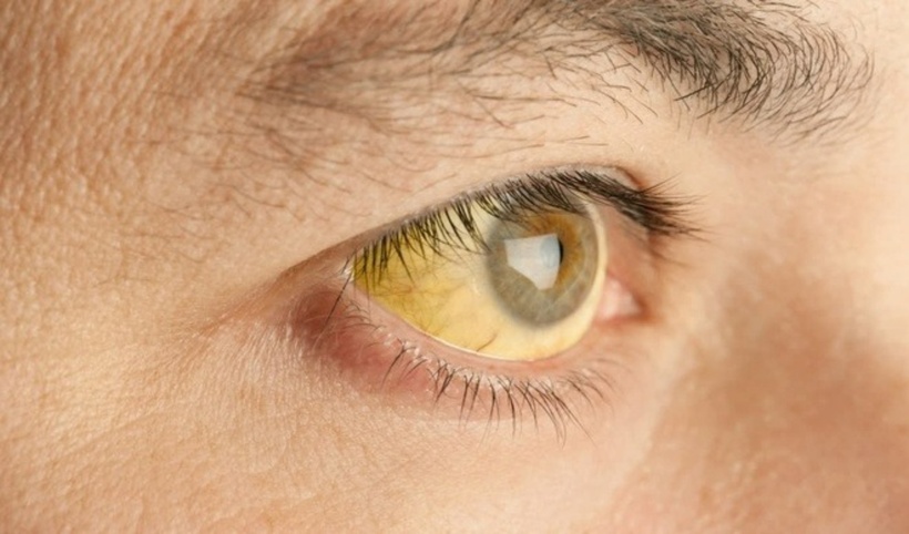 Vàng mắt là triệu chứng điển hình cảnh báo gan đang bị suy yếu mà mọi người cần đặc biệt lưu ý. Ảnh: Johns Hopkins Medicine.