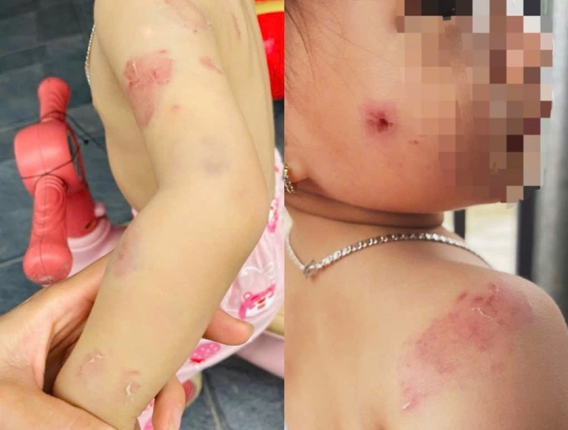 Vết thương trên người cháu bé 2 tuổi. Ảnh: Tiền Phong.