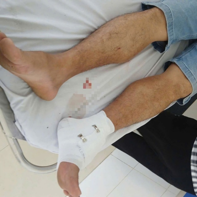Vết thương trên chân thầy giáo do bị cá sấu tấn công. Ảnh: Người Lao Động.