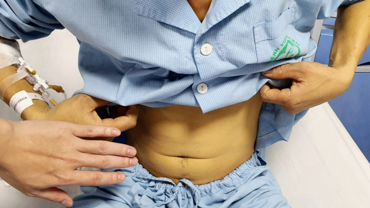 Nam bệnh nhân bị vàng da do suy gan vì uống mật cá trắm. Ảnh: VietNamNet.