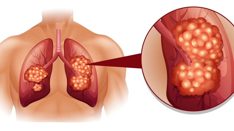 Ung thư phổi là một trong những căn bệnh ung thư nguy hiểm hàng đầu hiện nay.