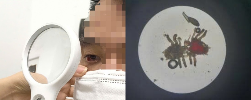 Phát hiện rận mu sau thời gian thường xuyên bị ngứa nhiều ở vùng mu, bìu và quanh hậu môn.