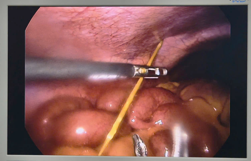 Dị vật được lấy bỏ kịp thời. Ảnh: SK&ĐS.