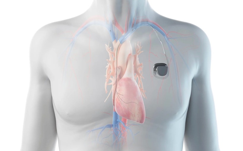 Bệnh nhân được chỉ định đặt máy tạo nhịp tim vĩnh viễn—thiết bị nhỏ gọn giúp duy trì nhịp đập bằng xung điện. Ảnh minh hoạ.