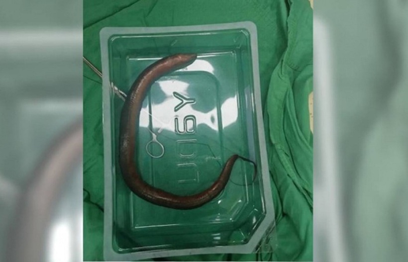 Con lươn được lấy ra trong bụng bệnh nhân. Ảnh: Xiaoxiang Morning Post