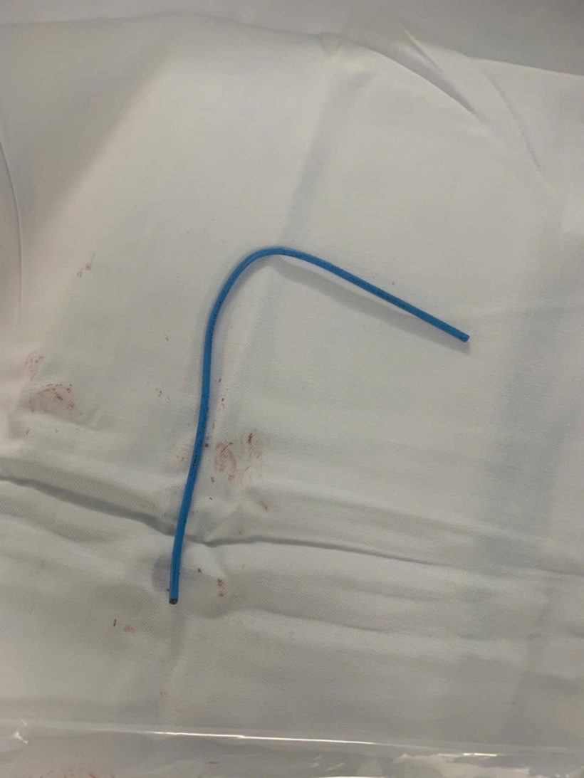 Dị vật được lấy ra. Ảnh: NLĐ.