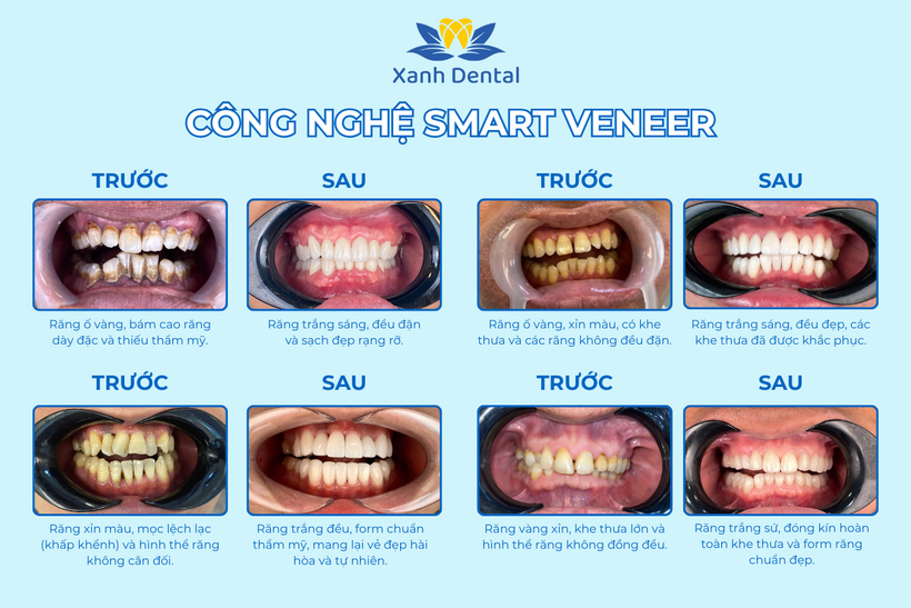 Nha khoa Xanh Dental khai trương cơ sở 2 đột phá với công nghệ Smart Veneer - 2