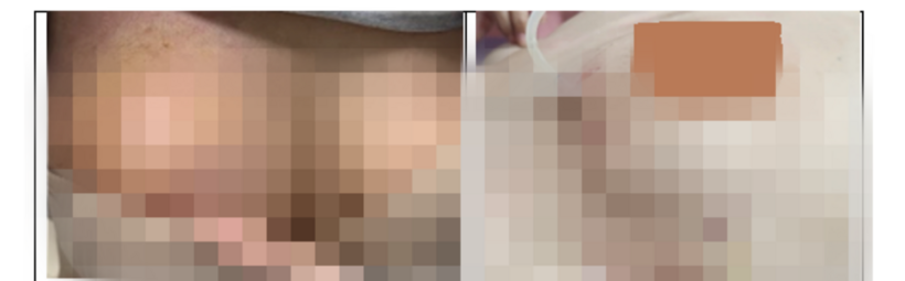 Trả giá đắt từ lời quảng cáo "nâng ngực không dao kéo"