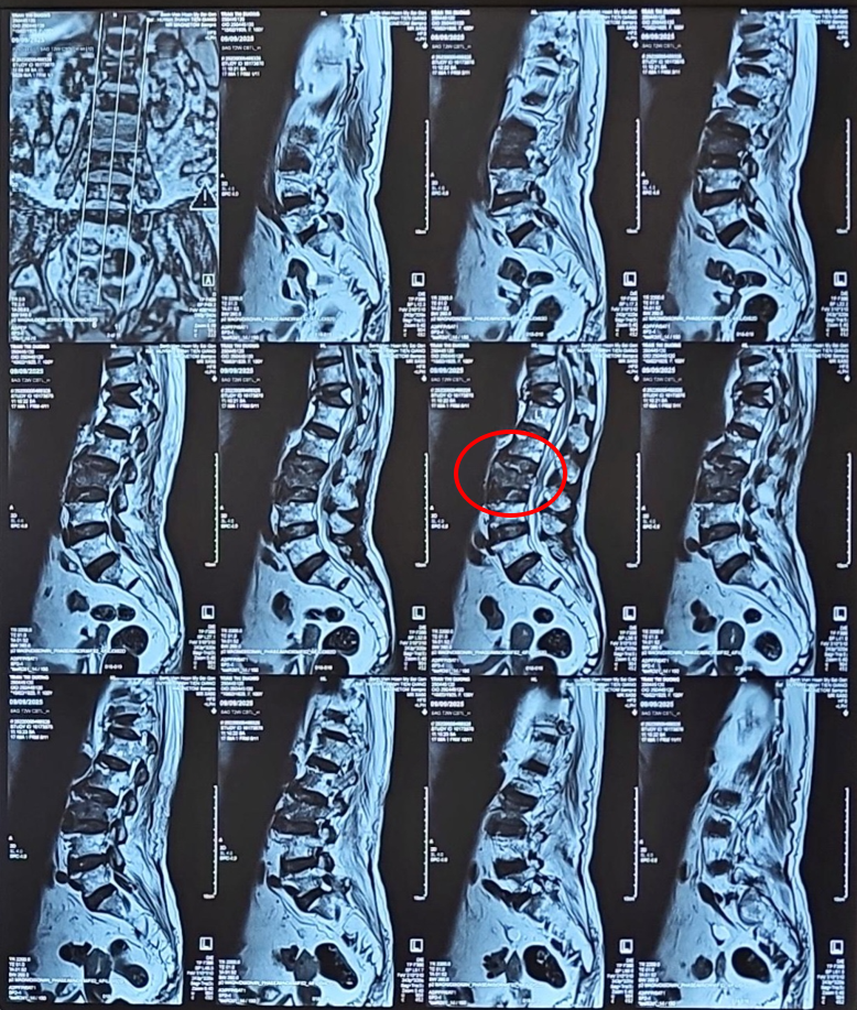 Hình ảnh MRI cho thấy gãy xẹp nhiều đốt sống trên nền loãng xương nặng, trong đó đốt L3 gãy cấp tính phù tủy xương